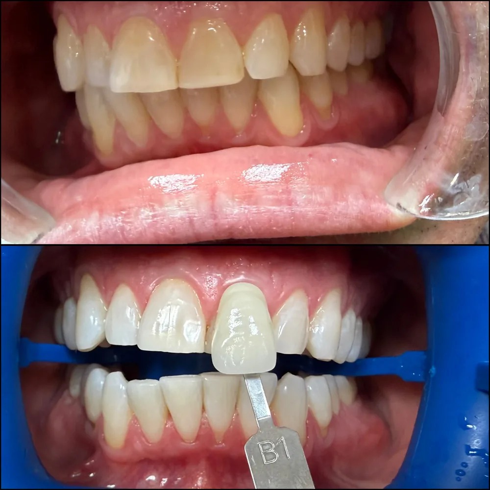 Before and after Zoom whitening at Sunset Smiles in Jupiter, FL — teeth several shades brighter against a dental shade guide.