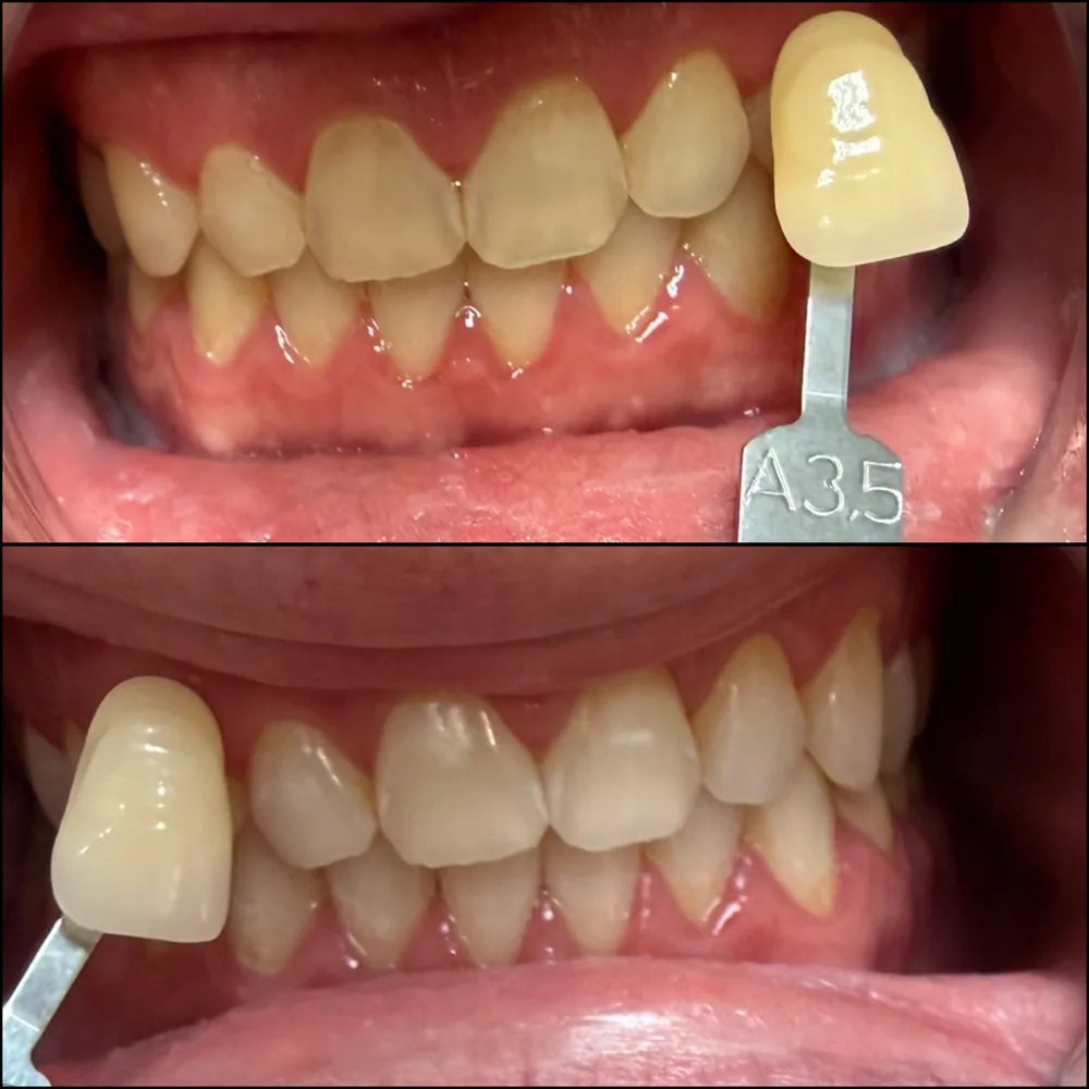 Before and after professional teeth whitening at Sunset Smiles Cosmetic Dentistry in Jupiter, FL, measured against a dental shade guide.