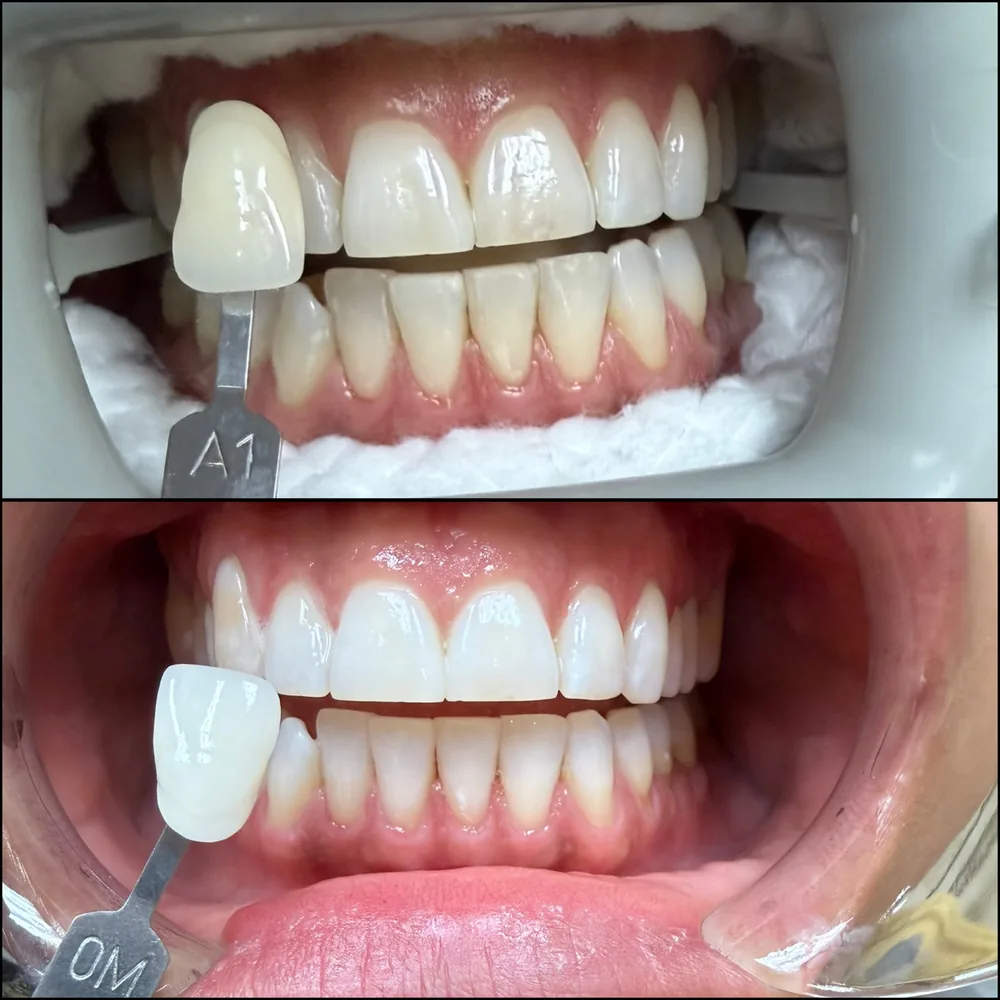 Before and after Zoom whitening results for a Jupiter, FL dental patient, shade guide showing a much brighter shade after treatment.