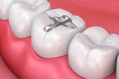 The image shows a dental implant inserted into a tooth with surrounding teeth.