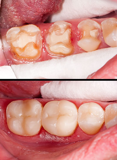 The image shows a close-up photograph of a person s mouth with teeth that are severely damaged due to dental decay, with some teeth missing and others showing signs of infection or decay, and a tongue partially visible in the bottom right corner.