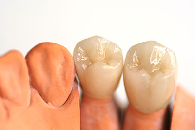 The image shows two rows of artificial teeth with visible crowns and fillings on either side, placed against a white background.