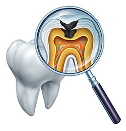 The image shows a magnified view of a tooth with an open crown, revealing the pulp chamber inside, which contains a root canal filling and a nerve. A dental mirror is placed over the tooth, reflecting its interior structure.