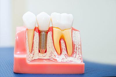The image shows a dental impression tray with teeth models and a screw visible, placed on a pink background.