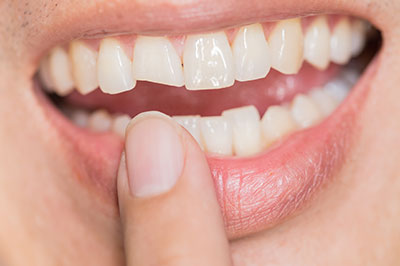 An individual with white teeth and a partial denture holding a finger under their chin in front of an open mouth.