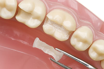 An image showcasing a dental implant being placed into a tooth socket with specialized tools.