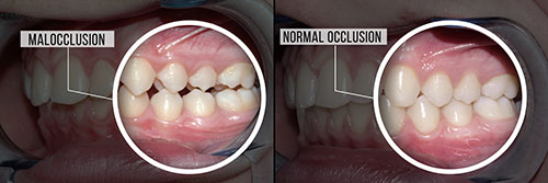The image shows two photographs of a person s teeth with an overlay of text indicating  MALOCCLUSION  and  NORMAL OCCLUSION,  highlighting the difference between malaligned and properly aligned teeth.