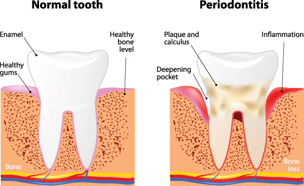 The image shows a medical illustration with three stages of tooth decay progression, labeled from normal to periodontitis, highlighting the difference between healthy gums and advanced dental disease.