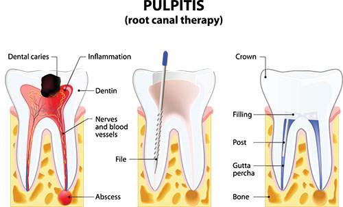 The image depicts a diagrammatic representation of dental pulpitis, illustrating inflamed dental pulp with accompanying annotations such as  root canal therapy,   dental caries,  and  file.