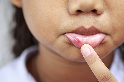 A young child with their finger on their lips, examining a red, swollen area around their mouth.