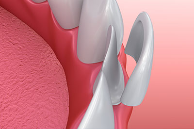 The image shows a close-up view of a dental implant with a screw visible on its surface, set against a red background.