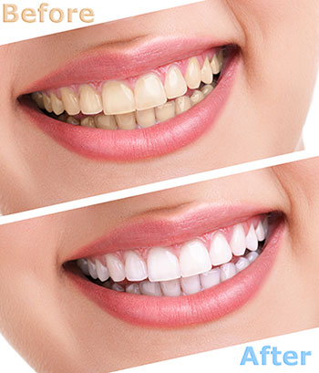The image displays a side-by-side comparison of a person s teeth before and after a dental treatment, showcasing the results of teeth whitening with two different shades of whiteness.