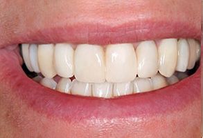 The image displays a close-up view of a person s smiling mouth with straight white teeth, showcasing a bright smile.