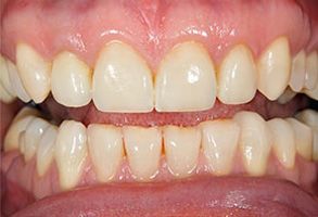 The image shows a close-up of a person s teeth with a focus on a yellowish discoloration, likely due to staining or decay.