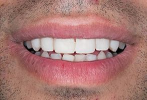 The image shows a close-up of a person s mouth with teeth visible, displaying a smile.
