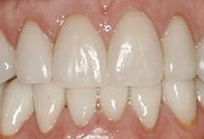 The image shows a close-up view of a person s teeth with visible staining or discoloration.
