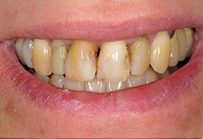The image shows a close-up view of a person s mouth with yellowed teeth and visible gum line, suggesting dental issues such as staining or decay.