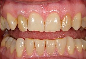 The image shows a close-up view of an individual s teeth with a focus on a noticeable yellowing or discoloration, which could be indicative of dental issues such as staining or decay.