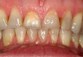 The image shows a close-up view of a person s teeth with a focus on dental health issues, such as discoloration and possible decay or damage.